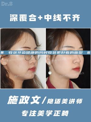 深覆合会怎样影响脸型