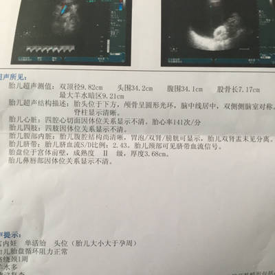 胎儿头偏大是什么原因