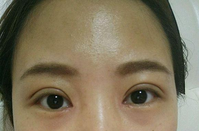 双眼皮太肿