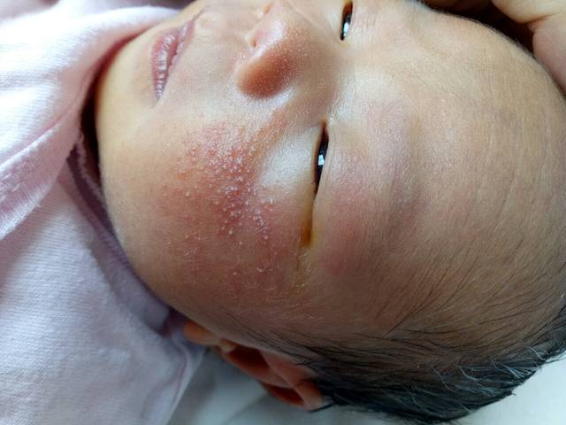 新生儿脸上长痤疮