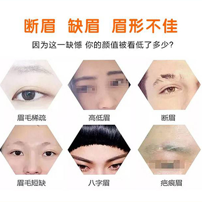 曲靖埋线双眼皮