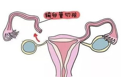 单侧输卵管怀孕的技巧