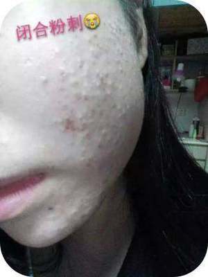 红奶白色痘痘