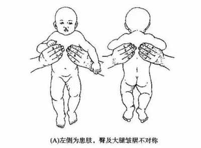 宝宝走路像鸭子