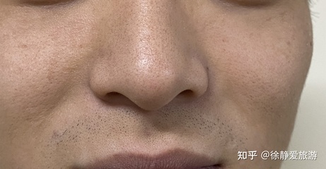 男生脸部毛孔粗大怎么办