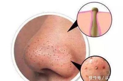 鼻子上面长白色痘痘原因