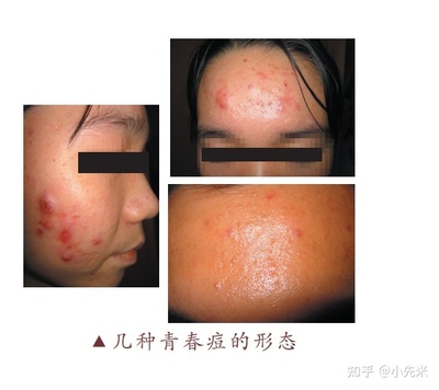 痘痘形成痤疮怎么办