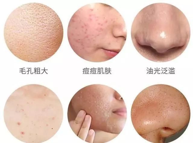 脸上毛孔堵塞