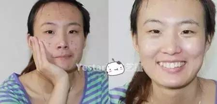 痘痘会不会越挤越多