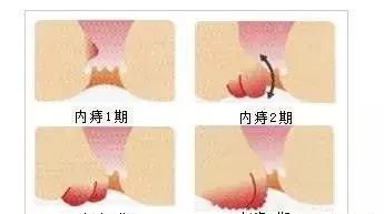 内痔二期怎么治疗