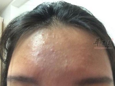 痘痘怎么治疗好
