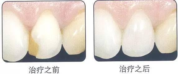 补牙后牙缝大了怎么办