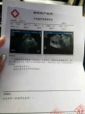 孕9周胎儿