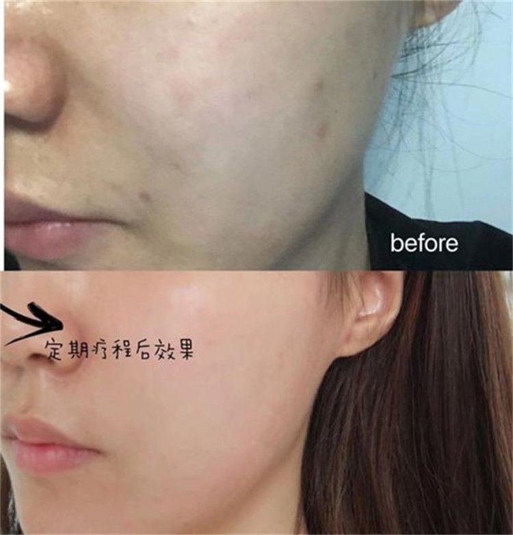 水光针后注意事项