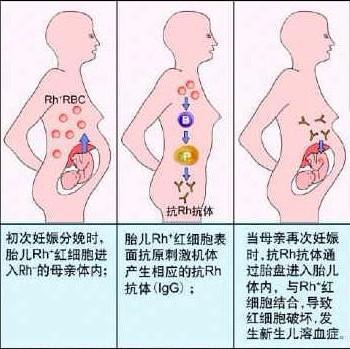 如何知道胎儿血型