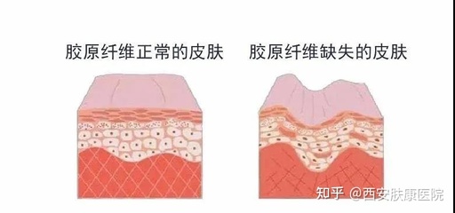 疤痕修复最佳时间