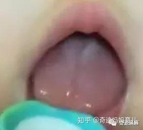 没有舌苔怎么治疗