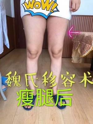 瘦腿哪里整容
