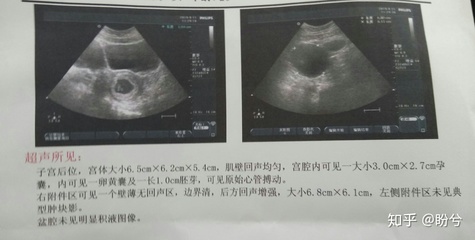 怀孕宫内有积液是怎么回事