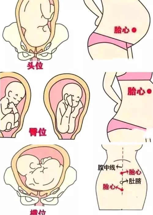 胎儿一直臀位说明宝宝有问题