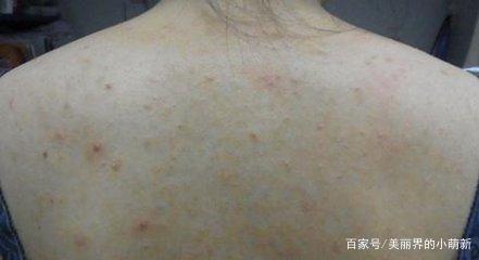 上火张痘痘疼