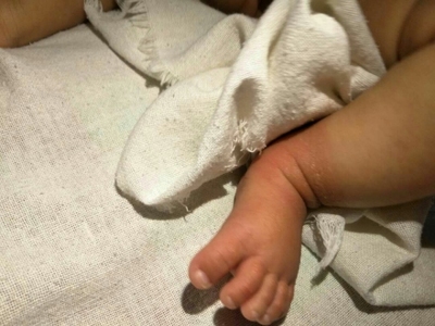 脚脖肿是怎么回事