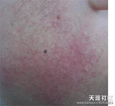 突然脸蛋长痘痘