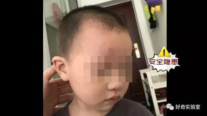 宝宝脸摔青了怎么办