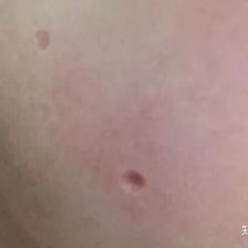 点痣留下的疤能消失吗