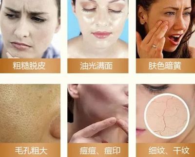 痘痘恢复后的毛孔粗大