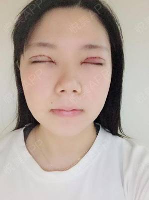 割双眼皮消炎针打几天