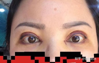 如何有双眼皮