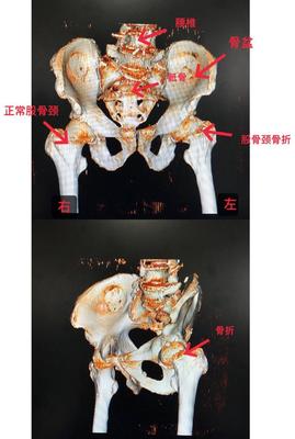 骨颈骨折后几个月能好