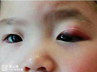 小孩眼睛疼是怎么回事