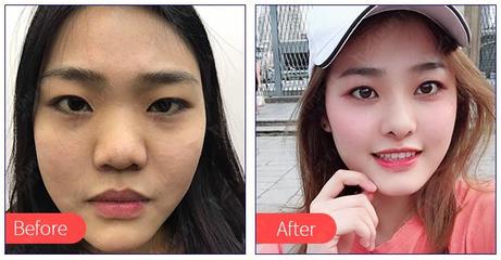 隆鼻效果怎么样