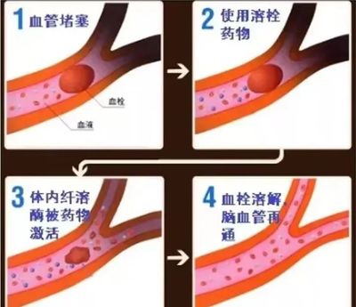 大血管堵塞怎么治疗