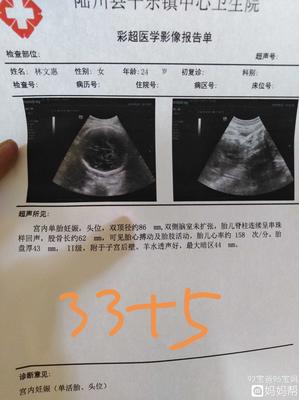 足月胎儿股骨长标准