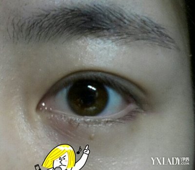 下眼皮长脂肪粒怎么办