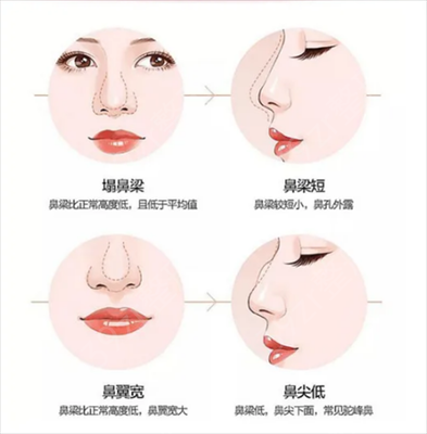 隆鼻可以侧身睡觉吗
