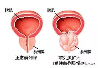 前列腺偏大是怎么回事