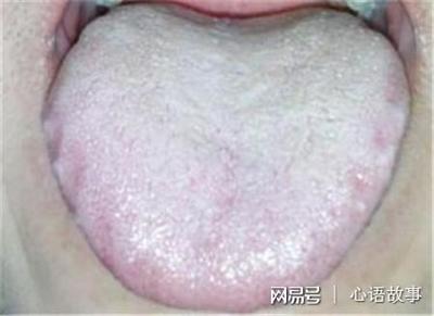 舌苔白厚腻是怎么回事