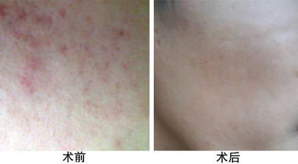 脸上长痘痘用肤大夫