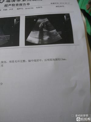 胎儿颅脑超声