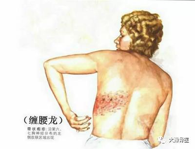 带状疱疹后遗神经痛怎么治疗