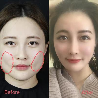 脸部吸脂费用是多少