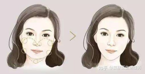 瘦脸针为什么会凹陷