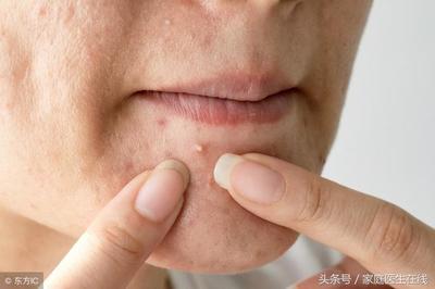 女生经期脸颊长痘痘怎么办