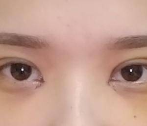 开眼角 增生
