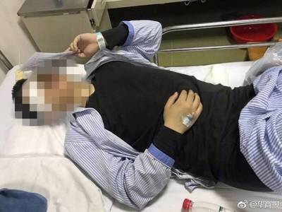 骨折两个月可以喝酒吗