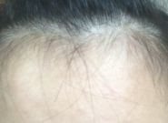 额头下边长痘痘怎么回事